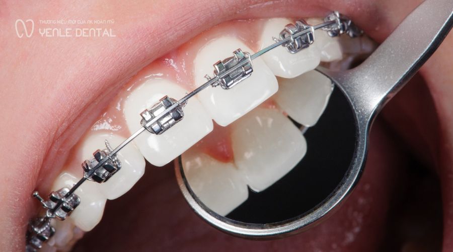 dấu hiệu sắp tháo niềng răng